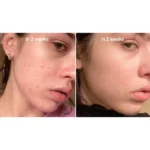 سرم نیاسینامید آنوا | ضد لک و روشن کننده - Image 2